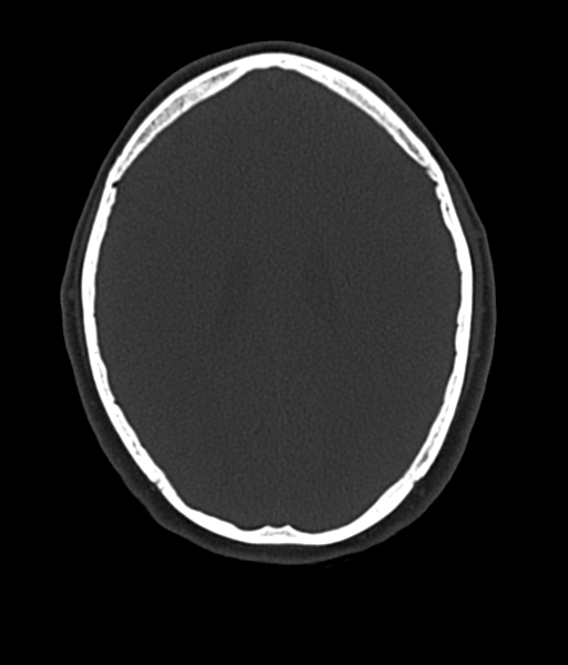 Cerebellar metastases - colorectal adenocarcinoma (Radiopaedia 40947-43652 AX Bone C- 2.0 MPR 41).png
