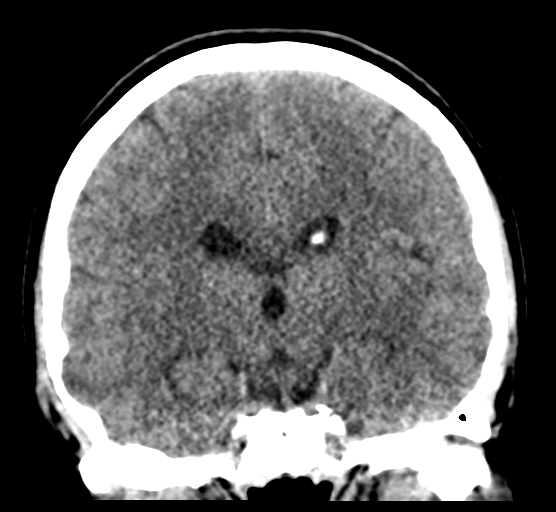 Cerebellar metastases - colorectal adenocarcinoma (Radiopaedia 40947-43652 Coronal non-contrast 53).png