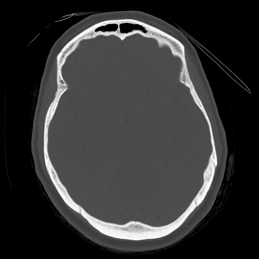 Cerebellar metastasis (cystic appearance) (Radiopaedia 41395-44258 Axial bone window 27).png