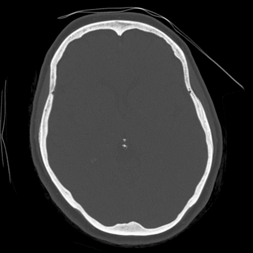 File:Cerebellar metastasis (cystic appearance) (Radiopaedia 41395-44258 Axial bone window 33).png