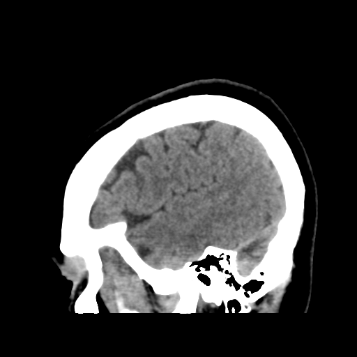 Cerebellar metastasis (cystic appearance) (Radiopaedia 41395-44258 E 45).png