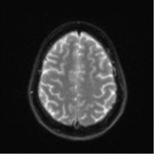 Cerebellar metastasis - adenocarcinoma lung (Radiopaedia 63184-71715 Axial DWI 24).png