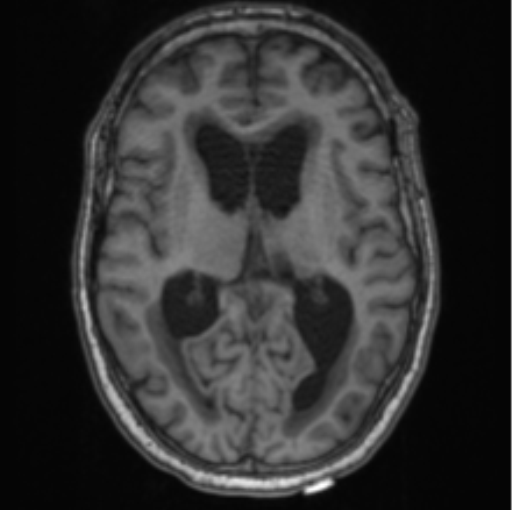 Cerebellar metastasis from lung adenocarcinoma (Radiopaedia 86690-102829 Axial T1 44).png