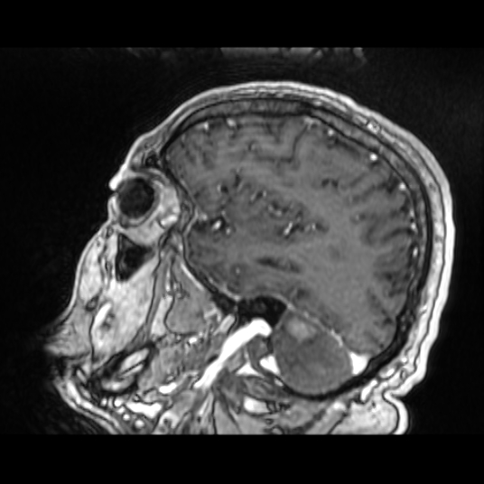 Cerebellar metastasis of pulmonary adenocarcinoma, cavernous venous malformation, and developmental venous anomaly (Radiopaedia 85827-101661 Sagittal T1 C+ 30).jpg