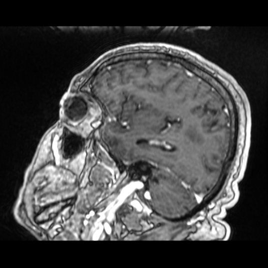 Cerebellar metastasis of pulmonary adenocarcinoma, cavernous venous malformation, and developmental venous anomaly (Radiopaedia 85827-101661 Sagittal T1 C+ 68).jpg