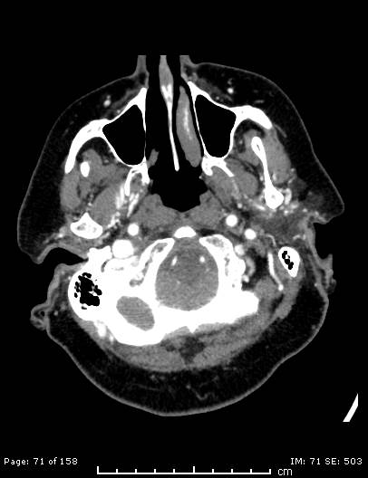 File:Cerebellar strokes due to intracranial giant cell arteritis (Radiopaedia 68799-78510 CT angiogram 71).jpg