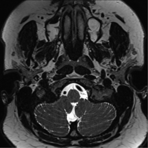 Cerebellopontine angle meningioma (Radiopaedia 48434-53348 Axial T2 Space 11).png