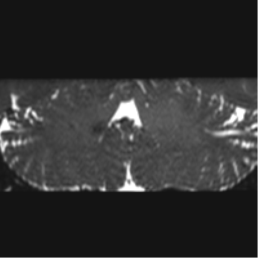 Cerebellopontine angle meningioma (Radiopaedia 48434-53348 Coronal T2 26).png