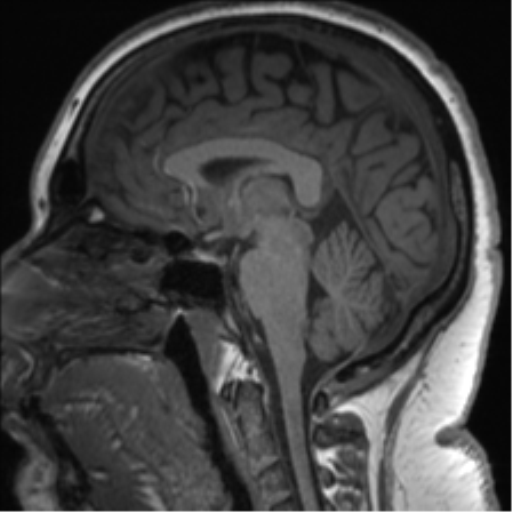 File:Cerebellopontine angle meningioma (Radiopaedia 48434-53348 Sagittal T1 46).png
