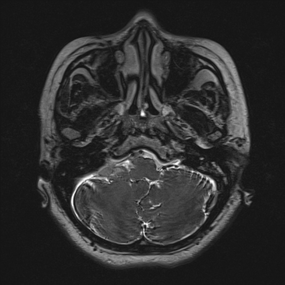 File:Cerebellopontine angle meningioma (Radiopaedia 53561-59591 Axial 3D volume T2 39).jpg