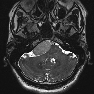 Cerebellopontine angle meningioma (Radiopaedia 72983-83680 Axial FIESTA 20).jpg