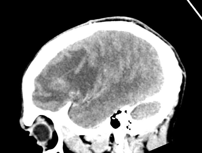 Cerebral abscess (Radiopaedia 60342-68008 Sagittal C+ delayed 40).png