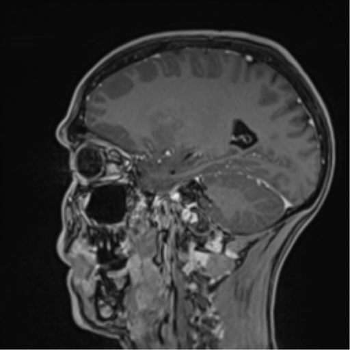 Cerebral abscess (Radiopaedia 60342-68009 J 22).png