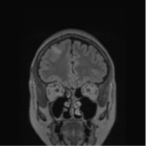 Cerebral abscess from pulmonary arteriovenous malformation (Radiopaedia 86275-102291 Coronal FLAIR 69).png