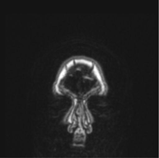 File:Cerebral abscess from pulmonary arteriovenous malformation (Radiopaedia 86275-102291 Coronal T1 88).png