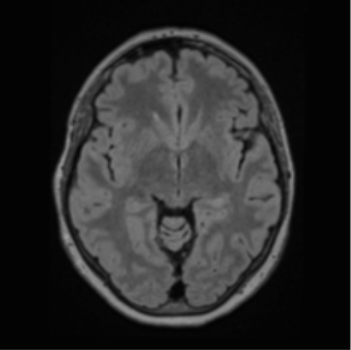 File:Cerebral abscess from pulmonary arteriovenous malformation (Radiopaedia 86275-102291 J 36).png