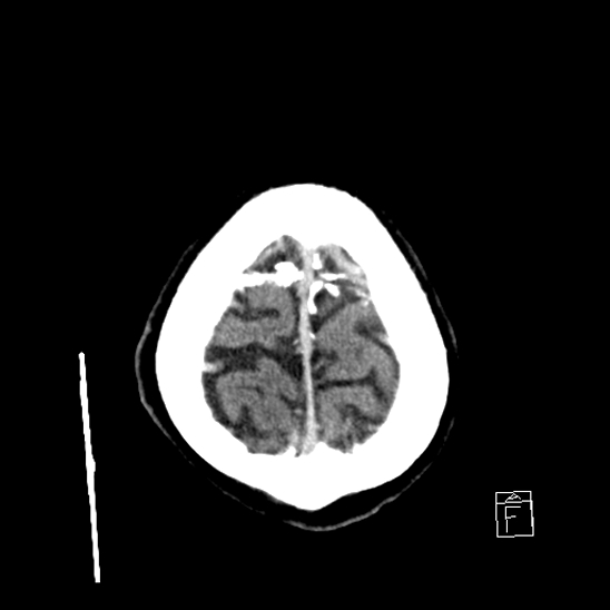 File:Cerebral abscess with ventriculitis (Radiopaedia 78965-91877 A 44).jpg