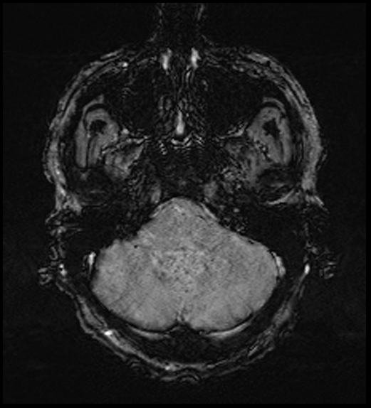 Cerebral abscess with ventriculitis (Radiopaedia 78965-91878 Axial SWI 13).jpg
