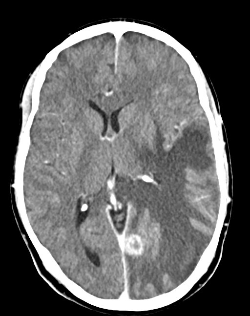 Cerebral abscesses (Radiopaedia 70458-80568 Axial Contrast 33).jpg