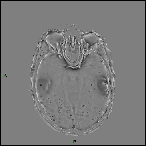 Cerebral amyloid angiopathy (Radiopaedia 77506-89664 H 42).jpg