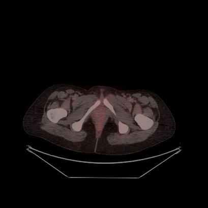 Cerebral and abdominal tuberculosis (Radiopaedia 90499-107853 C 245).jpg