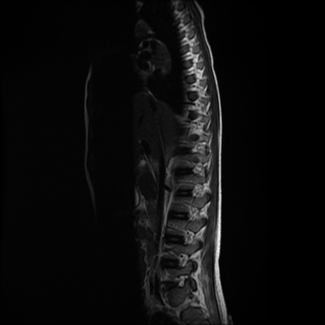 File:Cerebral and spinal tuberculosis (Radiopaedia 90489-107912 Sagittal T2 10).jpg