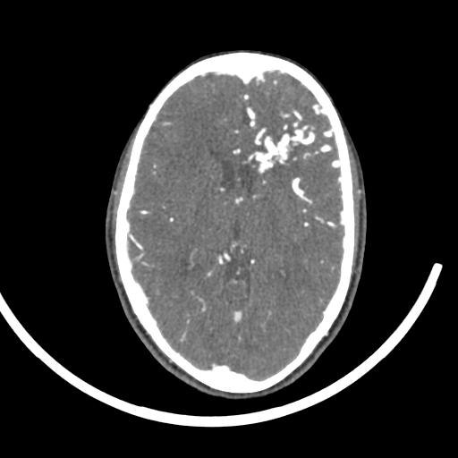 Cerebral arteriovenous malformation (Radiopaedia 29531-30031 E 12).jpg