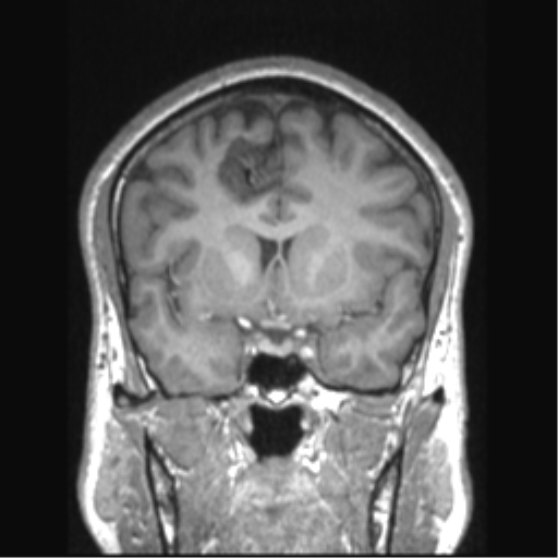 File:Cerebral arteriovenous malformation (Radiopaedia 39259-41506 Coronal T1 58).png