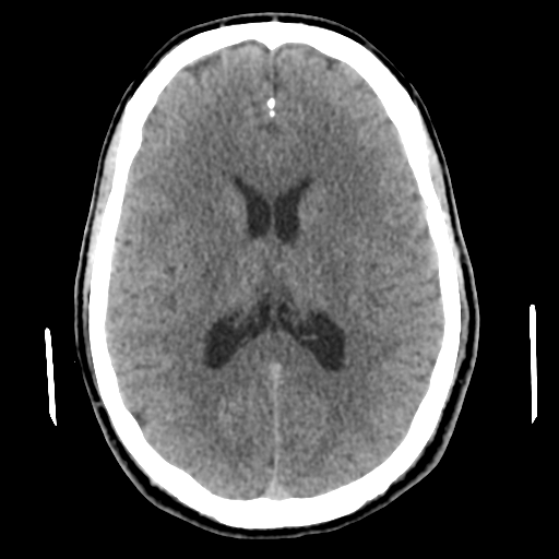 File:Cerebral arteriovenous malformation (Radiopaedia 55798-62371 Axial non-contrast 32).png