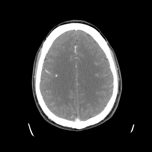Cerebral arteriovenous malformation (Radiopaedia 55798-62371 B 36).png
