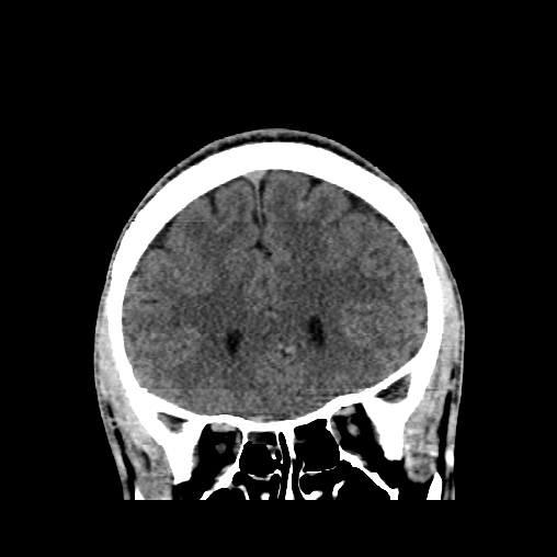 File:Cerebral arteriovenous malformation (Radiopaedia 61964-70028 Coronal non-contrast 18).jpg