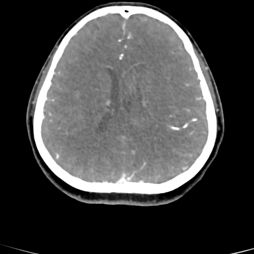 Cerebral arteriovenous malformation (Radiopaedia 73830-84645 B 40).jpg