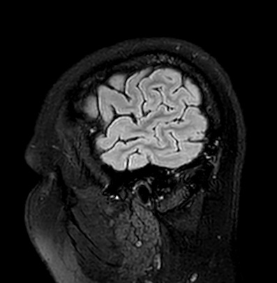 Cerebral arteriovenous malformation (Radiopaedia 74411-85746 Sagittal FLAIR 9).jpg
