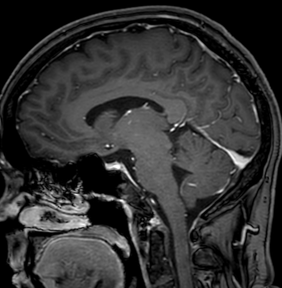 Cerebral arteriovenous malformation (Radiopaedia 74411-85746 Sagittal T1 C+ 59).jpg