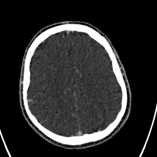 Cerebral arteriovenous malformation (Radiopaedia 78188-90746 Axial C+ delayed 127).jpg