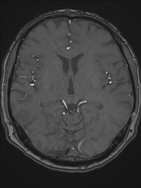 Cerebral arteriovenous malformation (Radiopaedia 84015-99245 Axial TOF 124).jpg