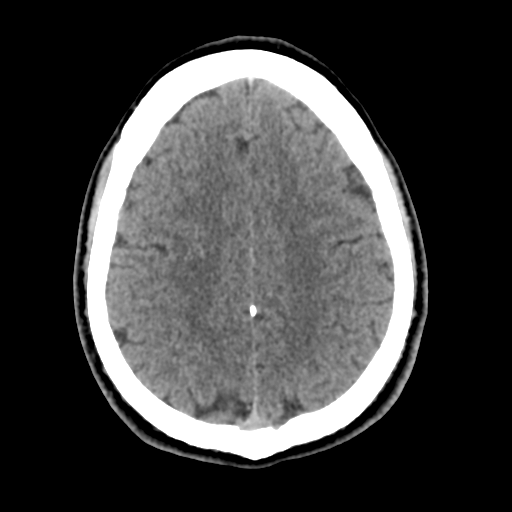 File:Cerebral arteriovenous malformation (Spetzler-Martin grade 2) (Radiopaedia 41262-44076 Axial non-contrast 41).png