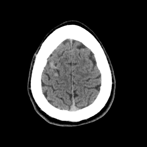 Cerebral arteriovenous malformation (Spetzler-Martin grade 2) (Radiopaedia 41262-44076 Axial non-contrast 47).png