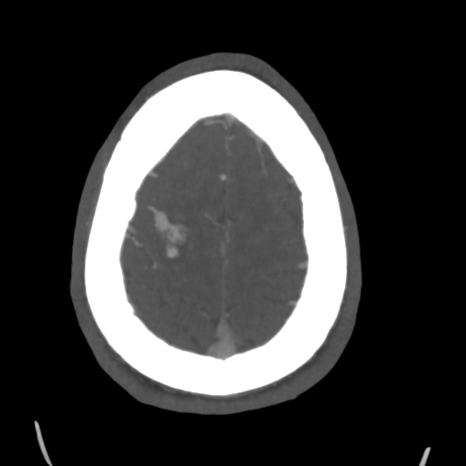 Cerebral arteriovenous malformation (Spetzler-Martin grade 2) (Radiopaedia 41262-44076 E 46).png