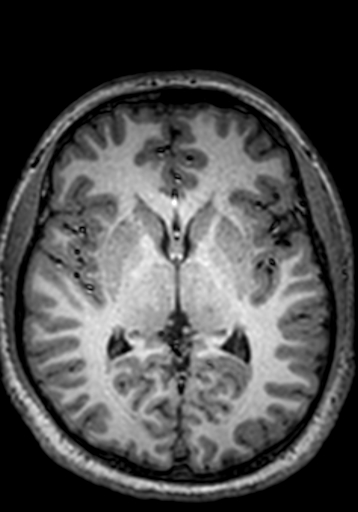 Cerebral arteriovenous malformation at posterior body of corpus callosum (Radiopaedia 74111-84925 Axial T1 144).jpg