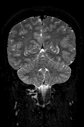 Cerebral arteriovenous malformation at posterior body of corpus callosum (Radiopaedia 74111-84925 Coronal T2 129).jpg