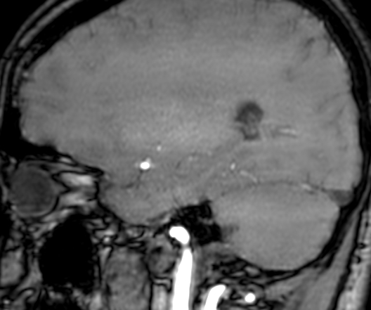 Cerebral arteriovenous malformation at posterior body of corpus callosum (Radiopaedia 74111-84925 J 274).jpg