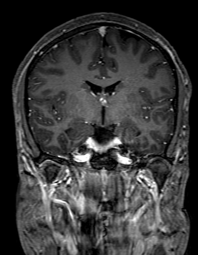Cerebral arteriovenous malformation at posterior body of corpus callosum (Radiopaedia 74111-84925 K 168).jpg