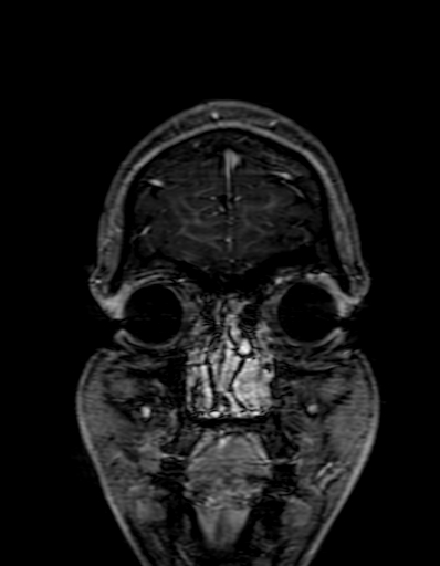 Cerebral arteriovenous malformation at posterior body of corpus callosum (Radiopaedia 74111-84925 K 20).jpg