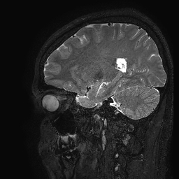 Cerebral arteriovenous malformation at posterior body of corpus callosum (Radiopaedia 74111-84925 Sagittal T2 40).jpg