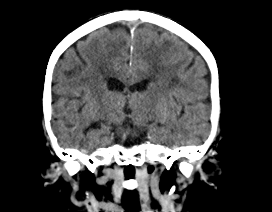 Cerebral arteriovenous malformation with lobar hemorrhage (Radiopaedia 44725-48510 Coronal non-contrast 27).png
