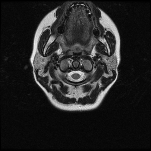 File:Cerebral autosomal dominant arteriopathy with subcortical infarcts and leukoencephalopathy (CADASIL) (Radiopaedia 41018-43763 Ax T2 C2-T1 1).png