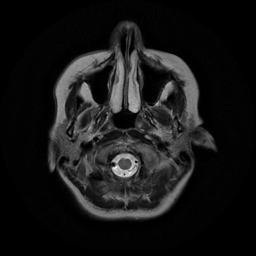 File:Cerebral autosomal dominant arteriopathy with subcortical infarcts and leukoencephalopathy (CADASIL) (Radiopaedia 41018-43768 Ax T2 PROP 1).png