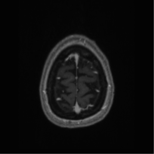 Cerebral cavernoma and development venous anomaly (Radiopaedia 37603-39482 Axial T1 C+ 70).png