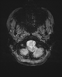 Cerebral cavernous venous malformation (Radiopaedia 70008-80021 I 4).jpg